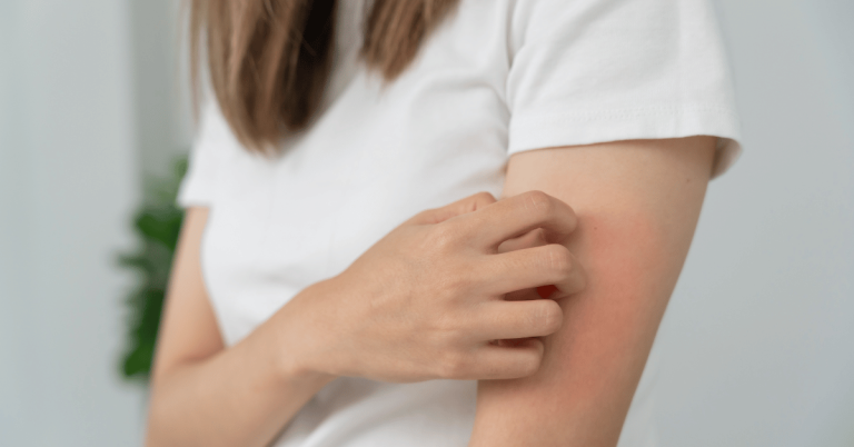 woman scratching rash on her skin from skin allergy to detergent